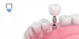 implantes dentales en Zaragoza